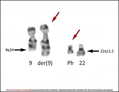 G-banded partial karyotype of translocation t(9;22)(q34;q11.2)