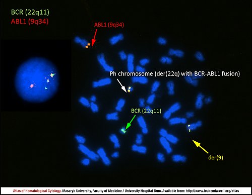 Fluorescence in situ hybridisation (FISH) of ''BCR-ABL1'' fusion