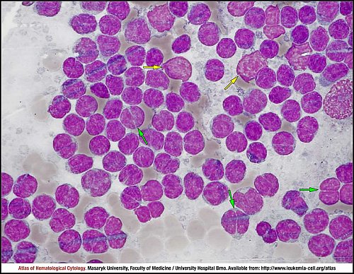 Lymph node, MGG (1000×)