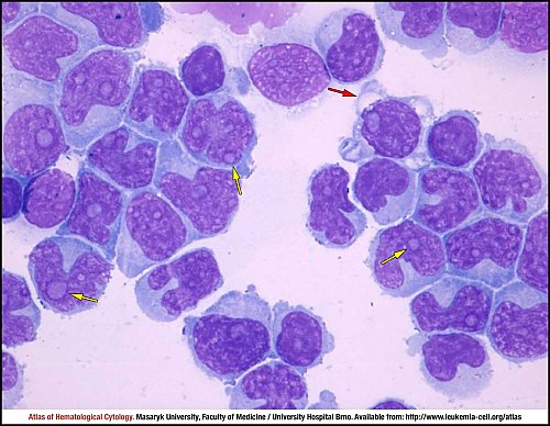 Cerebrospinal fluid, MGG (1000×)