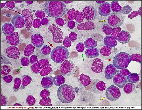 Lymph node, MGG (1000×)