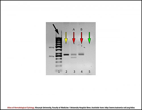 Agarose gel electropherogram for the detection of ''CALR'' mutations