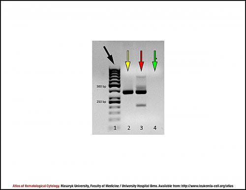 Agarose gel electropherogram for the detection of ''JAK2 V617F'' mutation