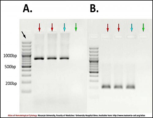 Agarose gel electropherogram of ''BCL2/IGH'' translocation detection in follicular lymphoma