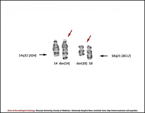 G-banded partial karyotype of translocation t(14;18)(q32;q21)