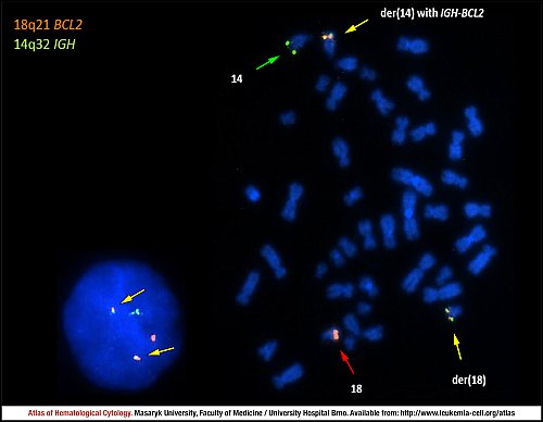 Fluorescence in situ hybridisation (FISH) of ''IGH-BCL2'' fusion