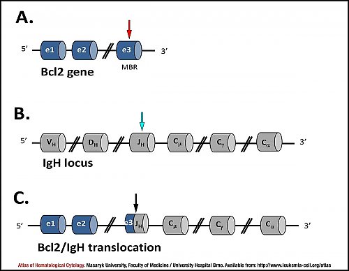 Schematic representation of t(14;18)(q32;q21) ''BCL2/IGH'' translocation in follicular lymphoma