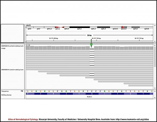 ''RUNX1'' sequencing analysis