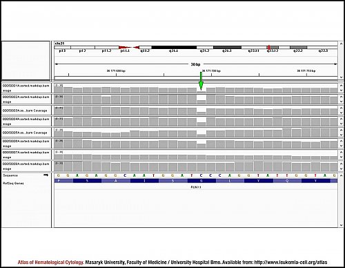 ''RUNX1'' sequencing analysis