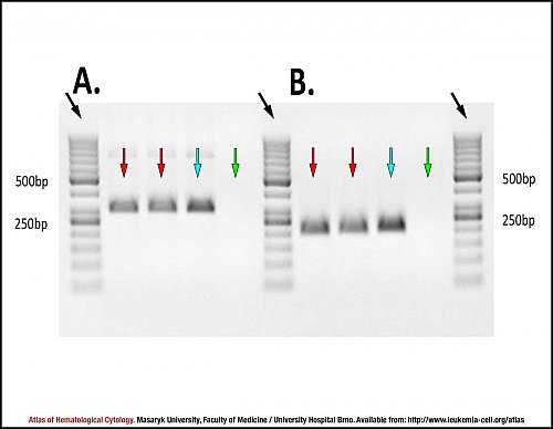 Agarose gel electropherogram for ''CCND1/IGH'' translocation detection in mantle cell lymphoma