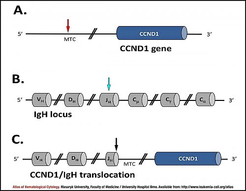 Schematic representation of t(11;14)(q13;q32) ''CCND1/IGH'' translocation in mantle cell lymphoma