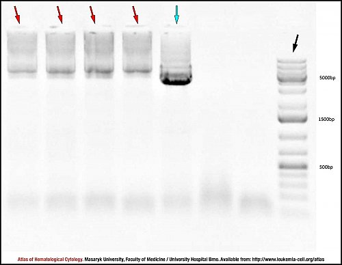 Agarose gel electropherogram of ''MYC/IGH'' translocation detection in sporadic Burkitt lymphoma