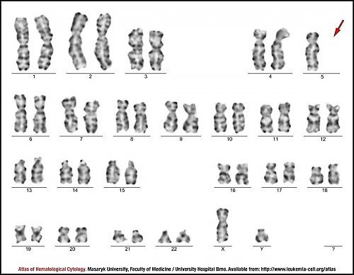 G-banded male karyotype with monosomy 5