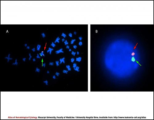 Fluorescence in situ hybridisation (FISH) of monosomy 5