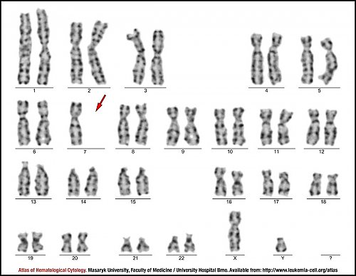 G-banded male karyotype of monosomy 7