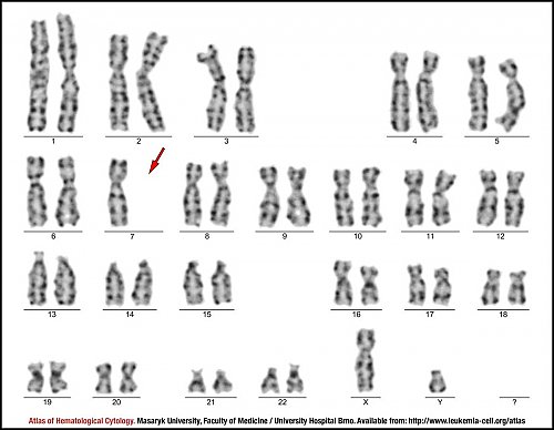 G-banded male karyotype of monosomy 7