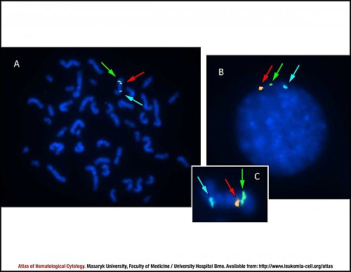 Fluorescence in situ hybridisation (FISH) of monosomy 7