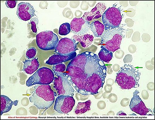 Pleural fluid MGG (1000×)