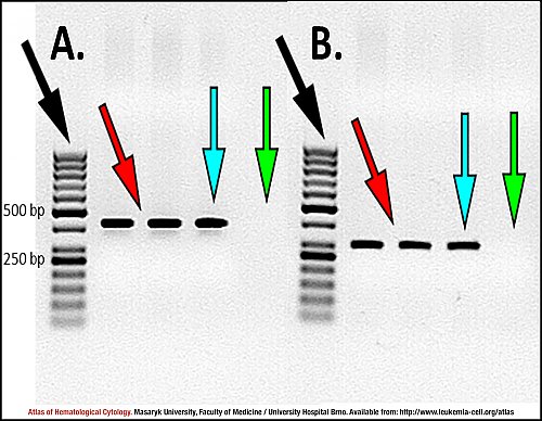 Agarose gel electropherogram for ''CBFB-MYH11'' (type A) transcript detection
