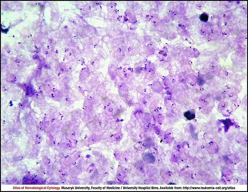 PB Giemsa stain (1000×)