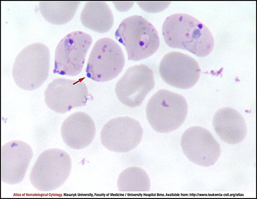 PB Giemsa stain (1000×)