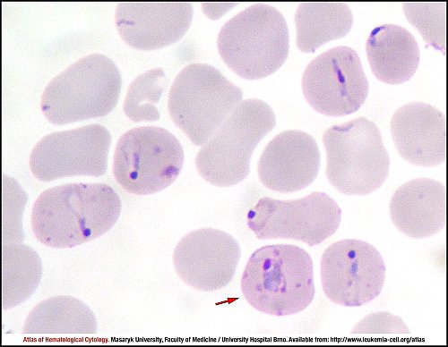 PB Giemsa stain (1000×)