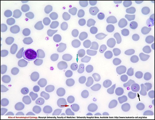 PB Giemsa stain (1000×)