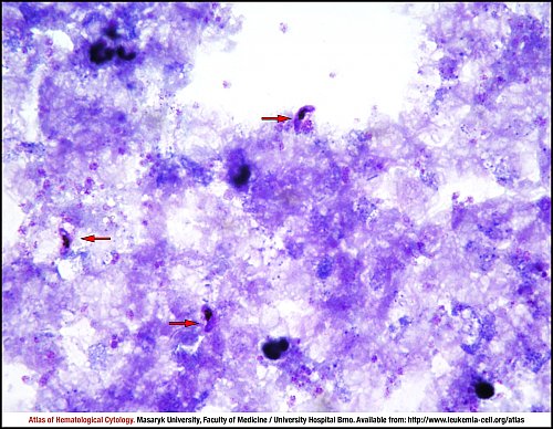 PB Giemsa stain (1000×)