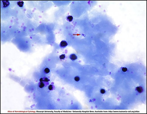 PB Giemsa stain (1000×)