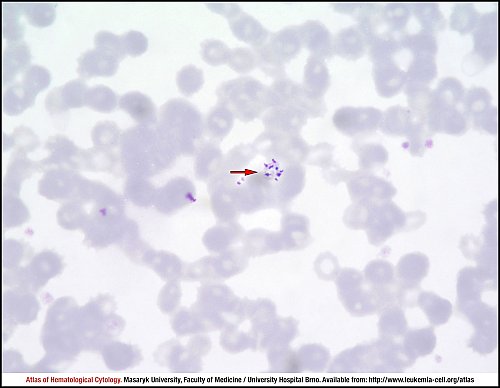 PB Giemsa stain (1000×)