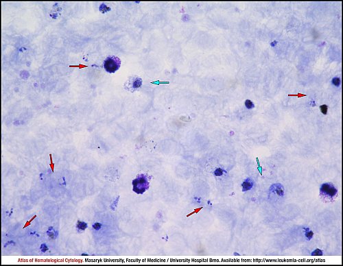 PB Giemsa stain (1000×)