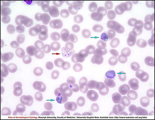 PB Giemsa stain (1000×)