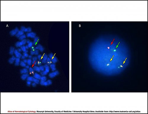 Fluorescence in situ hybridisation (FISH) of t(15;17)(q22;q21)