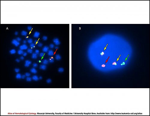 Fluorescence in situ hybridisation (FISH) of ''BCR-ABL1'' fusion
