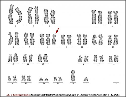G-banded male karyotype demonstrating trisomy of chromosome 8