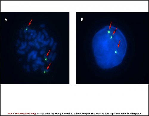Fluorescence in situ hybridisation (FISH) of trisomy 8