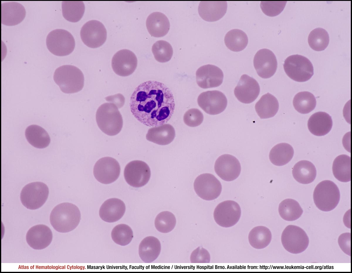 skelet legemliggøre Kræft Vitamin B12 deficiency - CELL - Atlas of Haematological Cytology