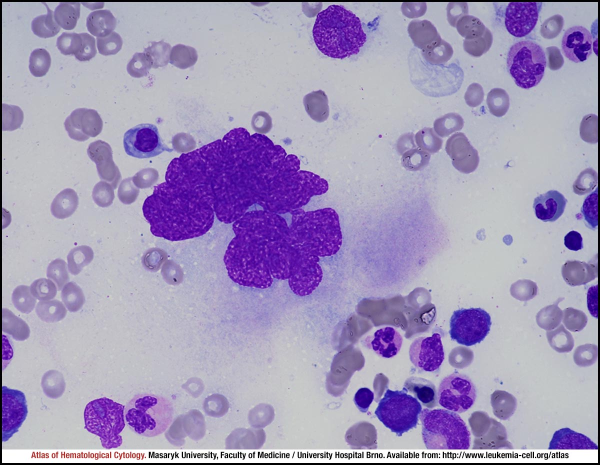 Vitamin B12 deficiency CELL Atlas of Haematological Cytology